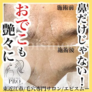 epismoo 脱毛/HBL/毛穴の眉毛・アイブロウイメージ