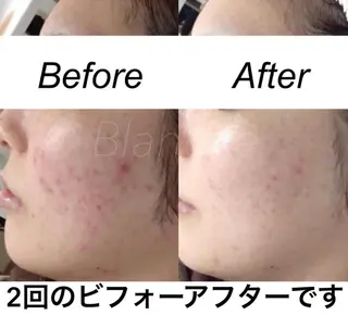 ミディアム カラー パーマ ヘアアレンジ キッズ ネイル マツエク・マツパ 都度払い肌質改善 &脱毛Blancheのエステ・リラクイメージ