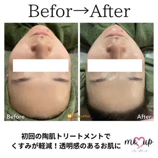 Meupニキビ専門店 背中/ハーブ/肌管理のその他イメージ