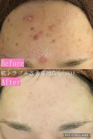 🔥3か月で肌革命 🔥ニキビ専門店のエステ・リラクイメージ
