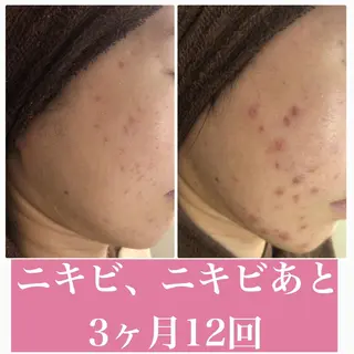 🔥3か月で肌革命 🔥ニキビ専門店のエステ・リラクイメージ