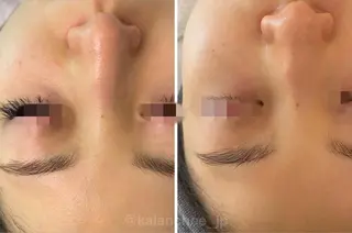 肌質改善 KALANCHOEのエステ・リラクイメージ