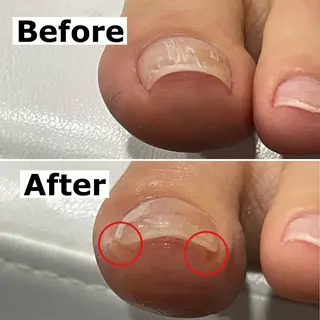 ネイル Mellow nail所属・巻爪無料モデル募集 ✨🦶MEGUMIのネイルデザイン