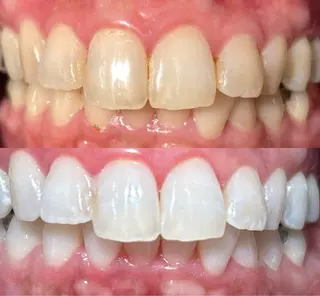 io teeth careのその他イメージ