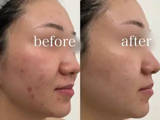 REVIハーブピーリング/バストケア/脱毛 Retea.【ルテア】所属・ハーブピーリング| 毛穴洗浄|ルテアのエステ・リラクイメージ