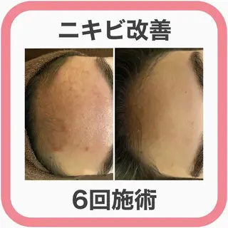 ニキビ跡改善専門🔥 医療にはできない改善のエステ・リラクイメージ