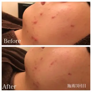 ショート パーマ ネイル マツエク・マツパ ニキビ跡専門サロン Ａｉｎａのエステ・リラクイメージ