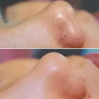 BeSkin藤沢店所属・ニキビ/肌質改善 BeSkin 藤沢店のエステ・リラクイメージ