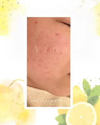 ニキビ跡専門サロン Ａｉｎａのエステ・リラクイメージ