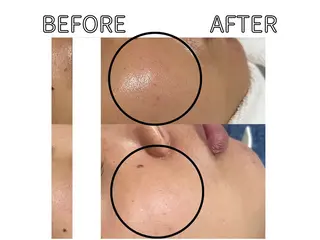 ハーブピーリング LIME池袋東口のエステ・リラクイメージ