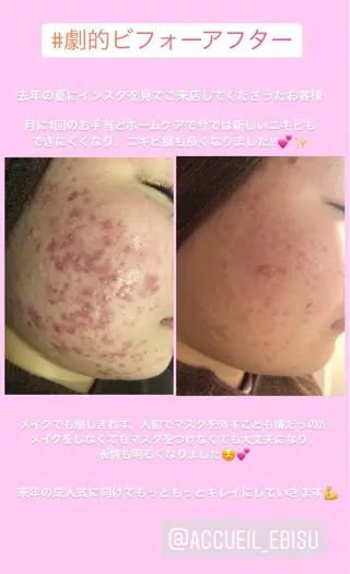 ミディアム カラー パーマ ヘアアレンジ メンズ キッズ ネイル マツエク・マツパ ニキビ・肌質改善専門 ♡人生が変わるサロンのエステ・リラクイメージ