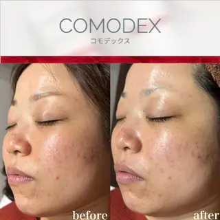 mieux所属・ハーブピーリング ¥6600のエステ・リラクイメージ