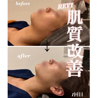 美容サロンAkazukin所属・REVI認定脱毛サ ロンAkazukinのエステ・リラクイメージ