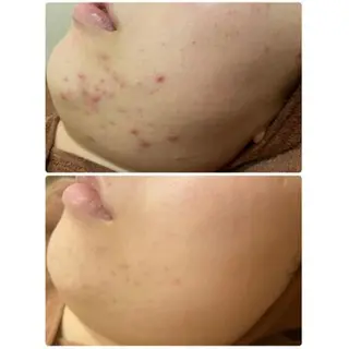 🔥3か月で肌革命 🔥ニキビ専門店のエステ・リラクイメージ