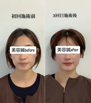 hari salon de off 美容鍼灸×小顔整体【ハリサロンドオフ】所属・美容鍼×小顔整体🤍 ishibashiのエステ・リラクイメージ