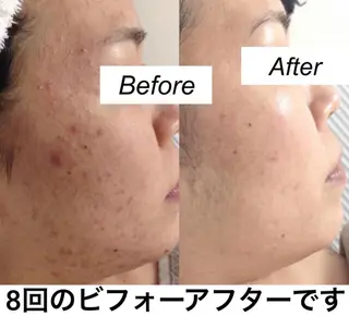 ミディアム カラー パーマ ヘアアレンジ キッズ ネイル マツエク・マツパ 都度払い肌質改善 &脱毛Blancheのエステ・リラクイメージ