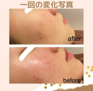 学生ニキビ改善🍀 優しい肌質改善のエステ・リラクイメージ