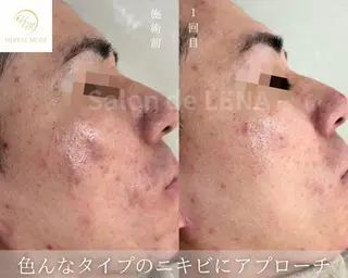 ハーブピーリング・毛穴ケア専門サロンSalon de LENA 栄店所属・ハーブピーリング専門 サロンドレナ　白藤のエステ・リラクイメージ