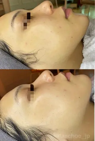 肌質改善 KALANCHOEのエステ・リラクイメージ