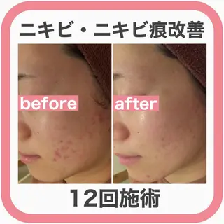 ニキビ跡改善専門🔥 医療にはできない改善のエステ・リラクイメージ