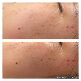 ロング カラー パーマ ヘアアレンジ メンズ キッズ ネイル マツエク・マツパ アイブロウ ニキビ特化型エステ 🍓最短で肌質改善のエステ・リラクイメージ