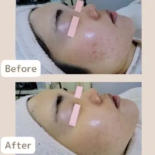 レチノール/ニキビ/ 毛穴ケア　浅川のエステ・リラクイメージ