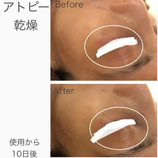 🔥3か月で肌革命 🔥ニキビ専門店のエステ・リラクイメージ