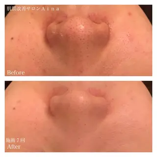 ミディアム パーマ キッズ ネイル マツエク・マツパ ニキビ跡専門サロン Ａｉｎａのエステ・リラクイメージ