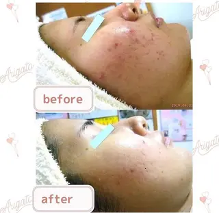 ニキビケア◇ニキビ跡 レゾン京橋店　八崎のエステ・リラクイメージ