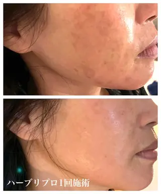 1ヶ月後も半分残る 高持続LEDエクステのマツエク・マツパデザイン