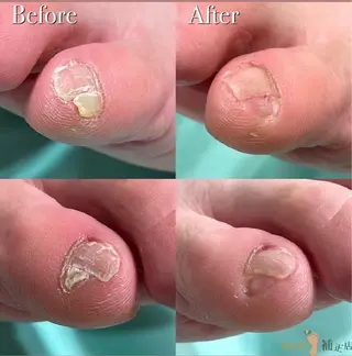 川崎巻き爪補正店所属・巻き爪アカデミー 溝の口のネイルデザイン