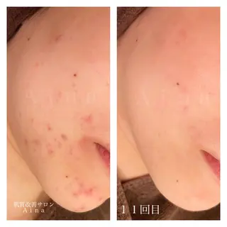 セミロング カラー パーマ ヘアアレンジ メンズ キッズ ネイル マツエク・マツパ ニキビ跡専門サロン Ainaのエステ・リラクイメージ