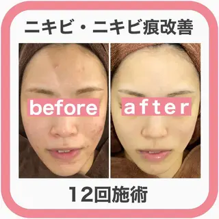 ニキビ跡改善専門🔥 医療にはできない改善のエステ・リラクイメージ
