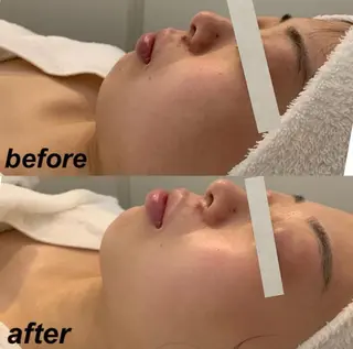 韓国/ピーリング 毛穴洗浄/POLAのエステ・リラクイメージ