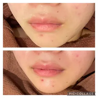 ミディアム カラー パーマ ヘアアレンジ メンズ キッズ ネイル マツエク・マツパ アイブロウ ニキビ特化型エステ 🍓最短で肌質改善のエステ・リラクイメージ