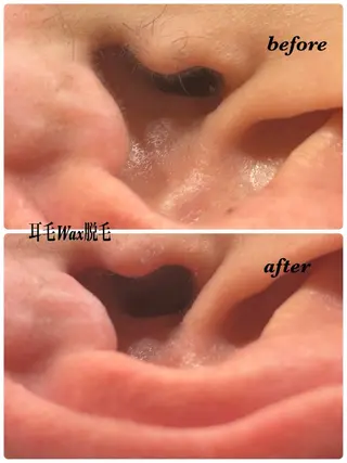 ハーブピーリング/韓国肌管理/フェイシャル/毛穴洗浄/眉毛/顔脱毛【糸脱毛専門】rev所属・ハーブピーリング🌹 毛穴洗浄❤️眉waxのエステ・リラクイメージ