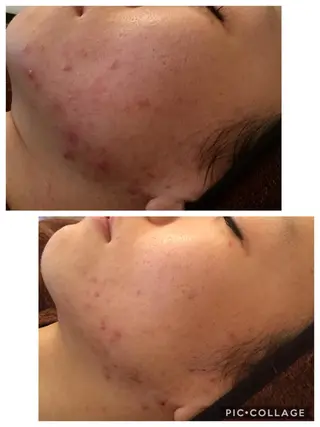 ニキビ/肌質改善専門 Snow skinのエステ・リラクイメージ