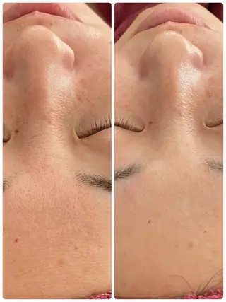 Chalon所属・REVI取扱・肌悩み 毛穴Chalonのエステ・リラクイメージ