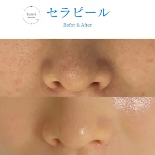 肌育専門サロンLumie所属・水玉リフティング🫧 Lumie恵比寿店のエステ・リラクイメージ