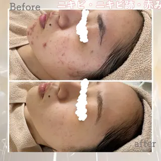 ニキビ&跡改善サロン オーナー光木のエステ・リラクイメージ