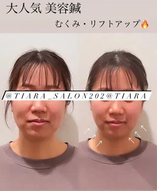 美容鍼灸サロン　TIARA所属・鍼灸サロン TIARA　美容鍼のエステ・リラクイメージ