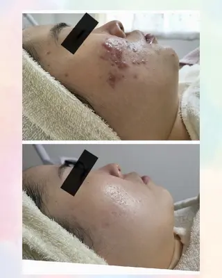 ニキビケア＆ニキビ跡 レゾン京橋店　のエステ・リラクイメージ