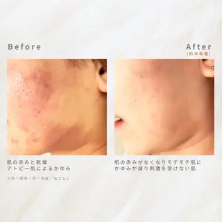 繰り返すニキビを改善 ✨つくば肌質改善専門のエステ・リラクイメージ