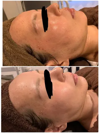 肌質改善ハーブピー リング🌿RINAのエステ・リラクイメージ