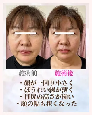 痩身・小顔・骨盤矯正×ヒップアップ専門エステ Peach所属・桃尻つかさ🍑小顔× ノーファンデ肌作りのエステ・リラクイメージ