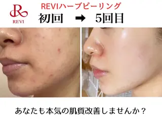 ハーブピーリング/韓国肌管理/フェイシャル/毛穴洗浄/眉毛/顔脱毛【糸脱毛専門】rev所属・ハーブピーリング🌹 毛穴洗浄❤️眉waxのエステ・リラクイメージ