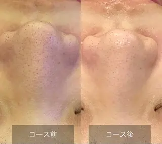 渋谷ベルゼ🌷木下 毛穴/脱毛/フェムのその他イメージ