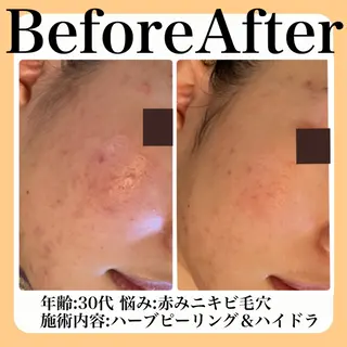 毛穴・たるみ･ニキビケア専門サロンsui所属・sui【スイ】 ARISAのエステ・リラクイメージ