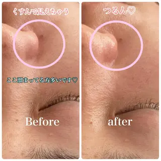 Chalon所属・REVI取扱・肌悩み 毛穴Chalonのエステ・リラクイメージ