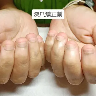 ネイル 深爪矯正/爪育成ケア manie nailのネイルデザイン